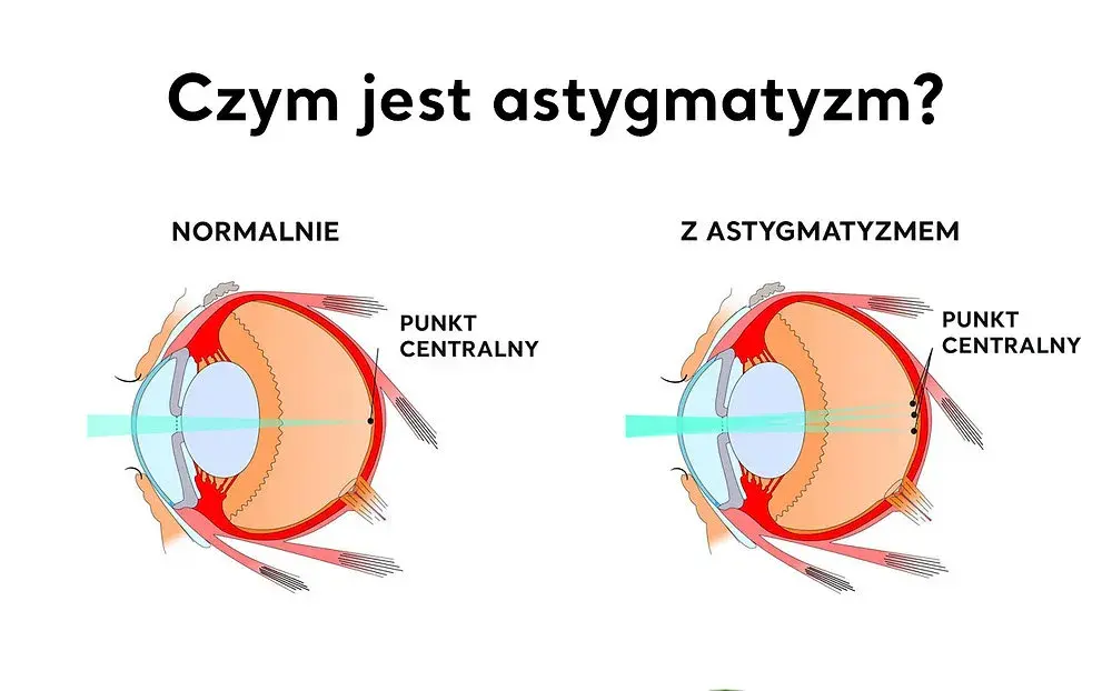 Jak wygląda astygmatyzm i jak wpływa na Twoje widzenie?