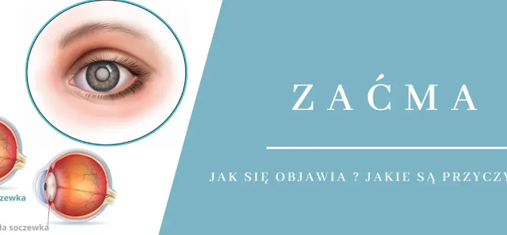 Dlaczego powstaje zaćma? Poznaj przyczyny i jak ich unikać