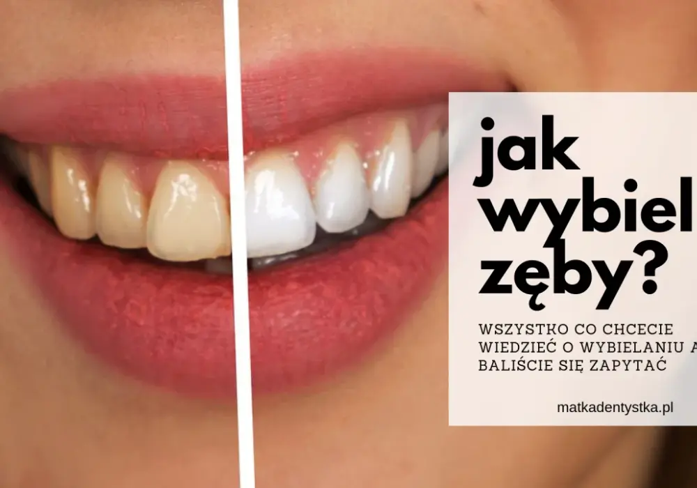 Jak wybielić zęby u dentysty - skuteczne metody i ich koszty