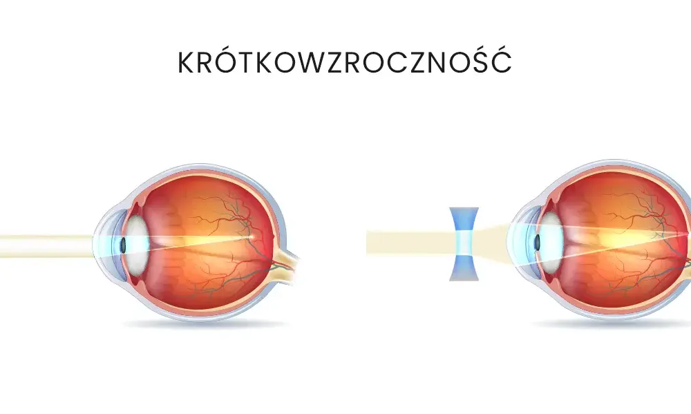 Krótkowzroczność u dzieci: kiedy okulary są naprawdę potrzebne?