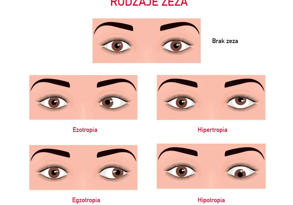 Od czego robi się zez? Poznaj przyczyny i jak ich uniknąć
