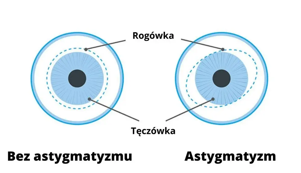 Astygmatyzm: okulista czy optometrysta? Który specjalista pomoże?