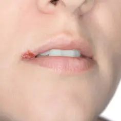 Czy można iść do dentysty z opryszczką? Sprawdź, jakie są ryzyka