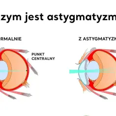 Jak wygląda astygmatyzm i jak wpływa na Twoje widzenie?