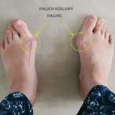 Jak uniknąć haluksów - skuteczne sposoby na zapobieganie bólowi stóp