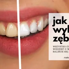 Jak wybielić zęby u dentysty - skuteczne metody i ich koszty