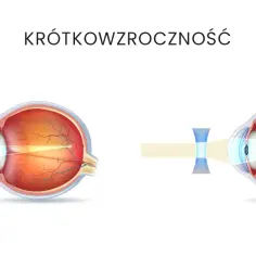 Krótkowzroczność u dzieci: kiedy okulary są naprawdę potrzebne?