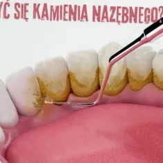 Jak usunąć kamień nazębny bez dentysty - skuteczne metody i pułapki