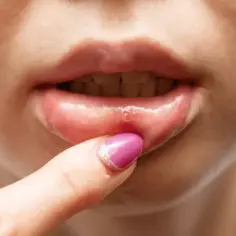 Czy z zimnem można iść do dentysty? Dowiedz się, co grozi