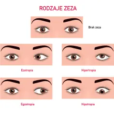 Od czego robi się zez? Poznaj przyczyny i jak ich uniknąć