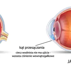 Czego unikać przy jaskrze, aby nie pogorszyć stanu oczu?