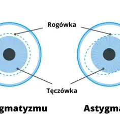 Astygmatyzm: okulista czy optometrysta? Który specjalista pomoże?