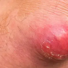 Czyrak dermatolog czy chirurg - kiedy konieczna jest operacja?
