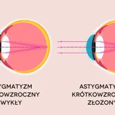 Czy astygmatyzm może się cofnąć? Fakty, które musisz znać
