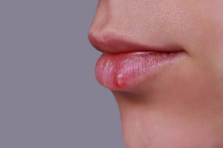 Zdjęcie Czy z zimnem można iść do dentysty? Dowiedz się, co grozi