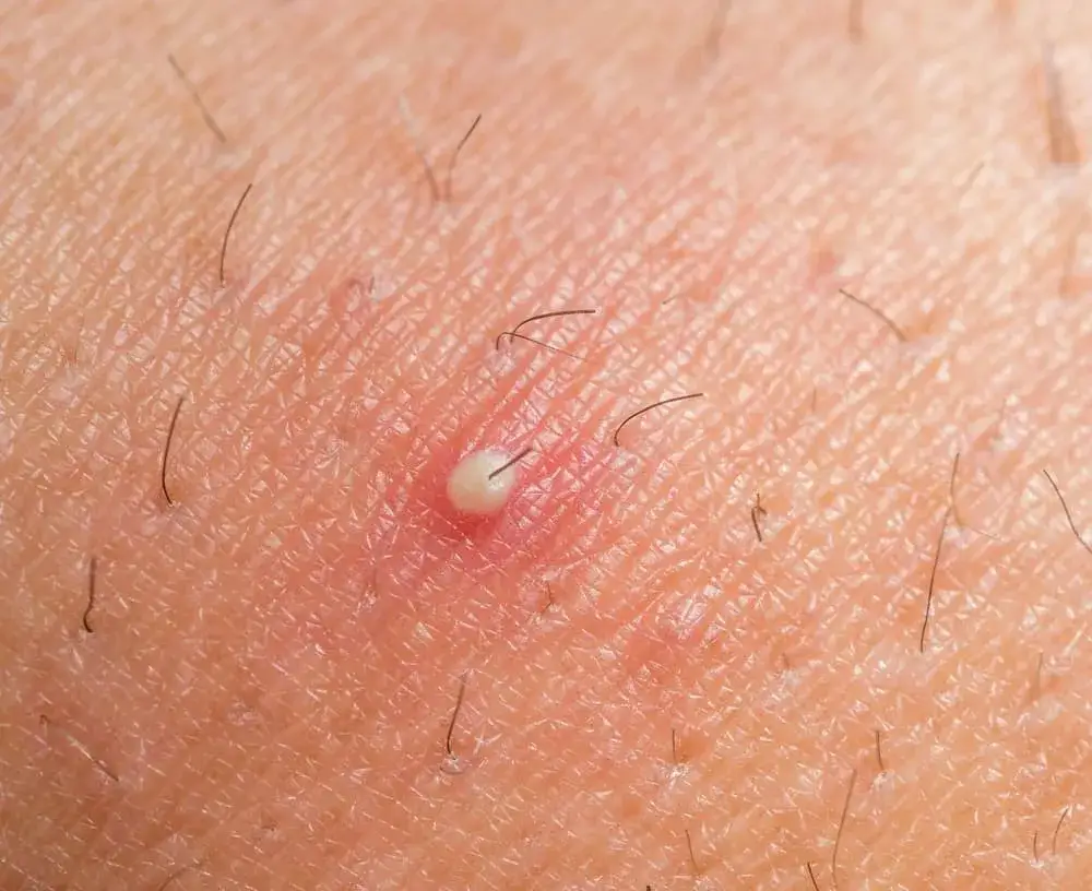 Zdjęcie Czyrak dermatolog czy chirurg - kiedy konieczna jest operacja?