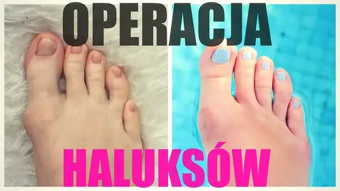 Zdjęcie Ile trwa rekonwalescencja po operacji haluksa i jak ją przyspieszyć