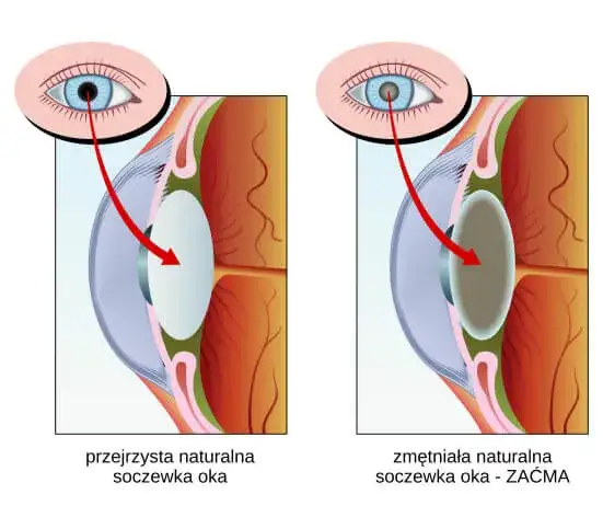 Zdjęcie Jak zatrzymać zaćmę? Skuteczne metody na opóźnienie jej rozwoju