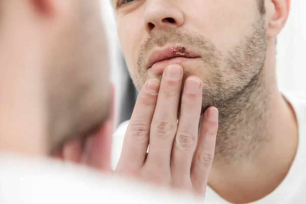 Zdjęcie Czy z opryszczką można iść do dentysty? Poznaj ryzyko i zalecenia