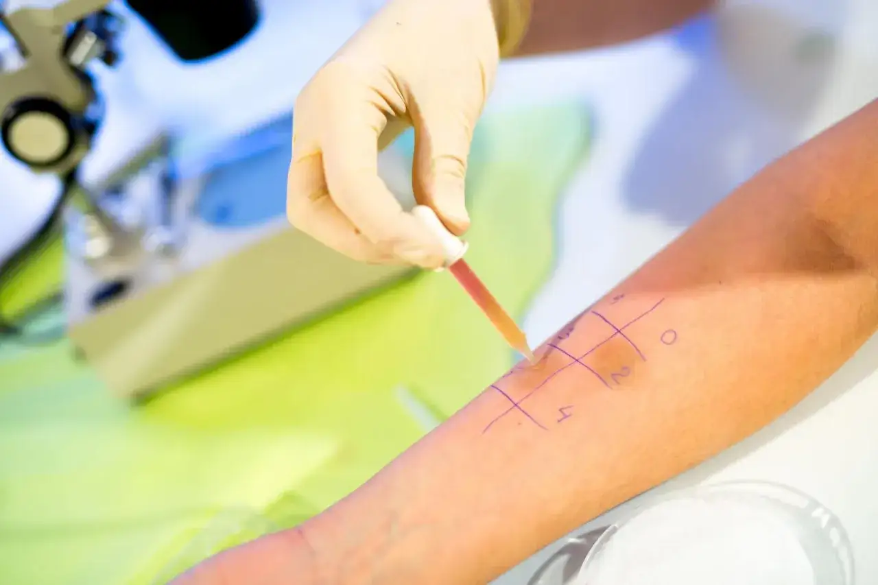 Zdjęcie Czy testy alergiczne są na NFZ? Sprawdź, co musisz wiedzieć