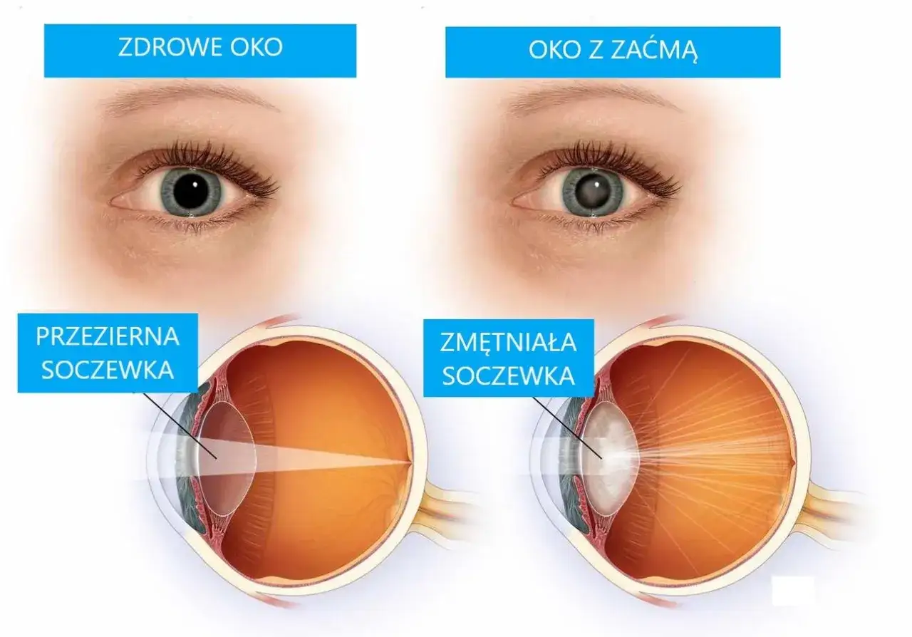 Zdjęcie Kiedy operować zaćmę? Objawy, które nie mogą być ignorowane
