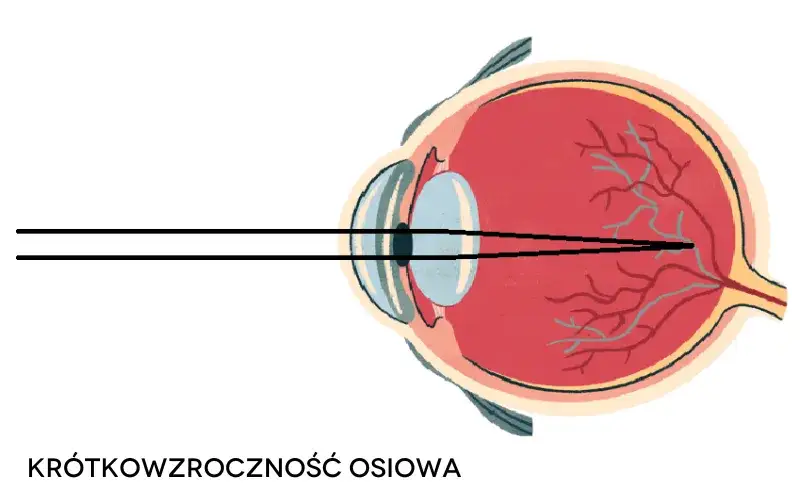 Zdjęcie Czy wadę wzroku minusy można wyleczyć? Prawda o krótkowzroczności