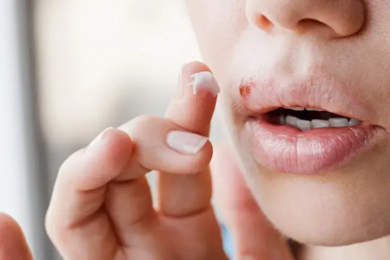 Zdjęcie Czy można iść do dentysty z opryszczką? Sprawdź, jakie są ryzyka