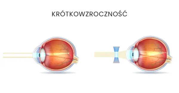 Krótkowzroczność u dzieci: kiedy okulary są naprawdę potrzebne?